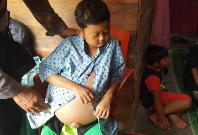 Adriansayah, bocah penderita penyakit kronis dan pembesaran perut, (Foto. Wayan Sukanta/SULTRAKINI.COM).