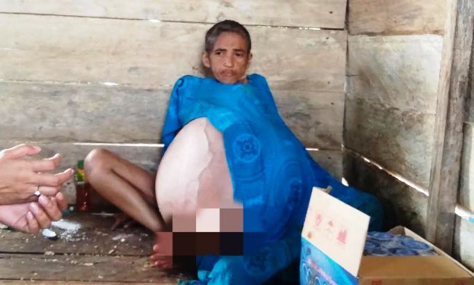 Ernis (32), seorang wanita warga Kabupaten Buton Utara mengalami pembekakan perut yang diduga akibat tumor selama tujuh tahun. (Foto: Ardian Saban/SULTRAKINI.COM.